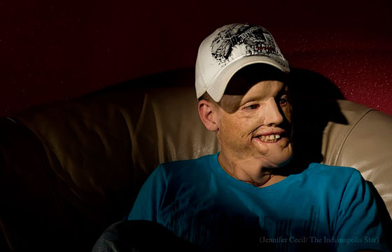 face transplant