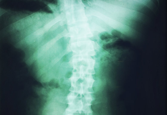 rubenstein-xray-1